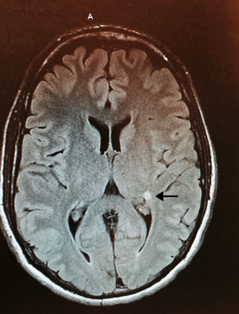 Steve Poltz's brain after his stroke.